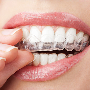 A close-up of a person s mouth with a clear aligner in place, showcasing a straight and well-maintained smile.