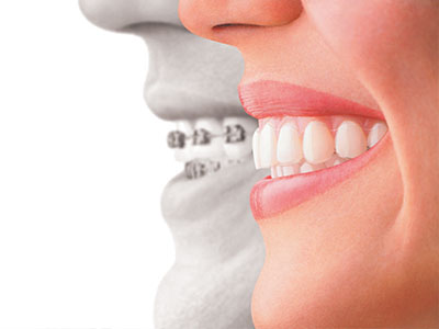The image shows a composite of a smiling human face with an overlay of a dental implant or bridge, highlighting the appearance and function of dental prosthetics.