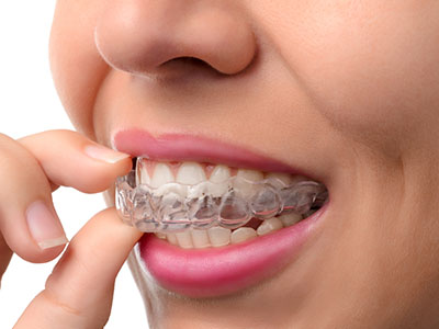 An image of a person with a clear aligner in their mouth, holding it up to inspect.